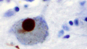 Lewy_Body_alphaSynuclein